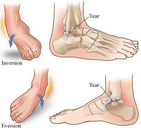 Ankle sprain, inversion sprain, eversion sprain, Fairview Physiotherapy and Rehabilitation Centre, physio, chiro, chiropractor, acupuncture, massage therapy, RT, registered therapist, osteopathy , osteo, rehab, recovery, physical therapy