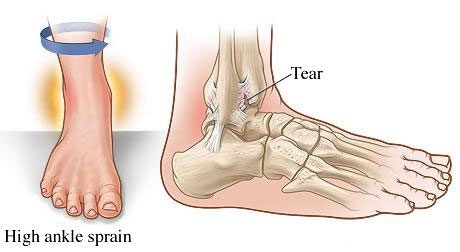 high ankle sprain, Fairview Physiotherapy and Rehabilitation Centre, physio, chiro, chiropractor, acupuncture, massage therapy, RT, registered therapist, osteopathy , osteo, rehab, recovery, physical therapy