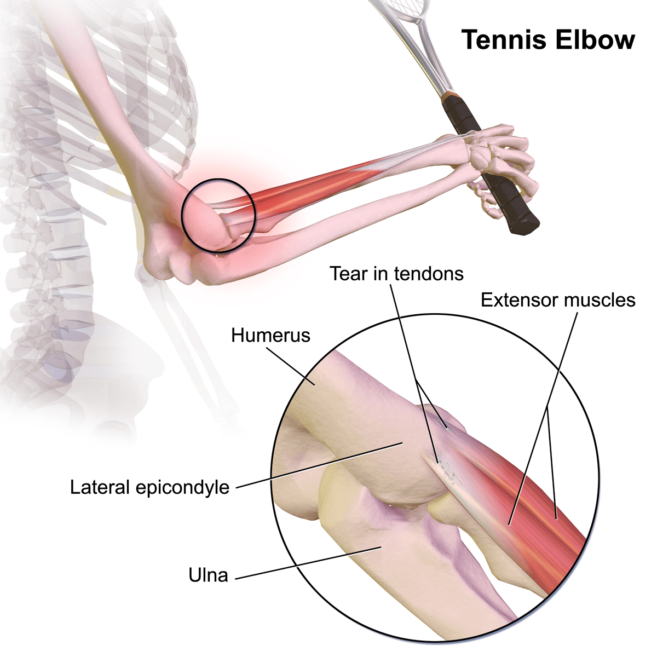 Tennis Elbow, Golfer's Elbow, Lateral Epicondylalgia, Injury, Recovery, Fairview Physiotherapy and Rehabilitation Centre, physio, chiro, chiropractor, acupuncture, massage therapy, RT, registered therapist, osteopathy , osteo, rehab, recovery, physical therapy