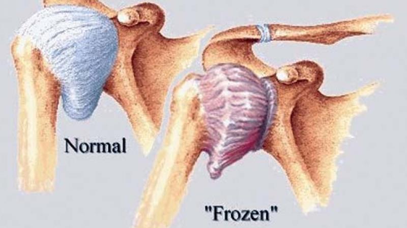 frozen shoulder, Staff, location, rehab clinic, rehabilitation clinic, fairview, Wynford, physiotherapy, physiotherapists, massage, massage therapy, RMT, Osteopathy, Osteopath, Chiropractor