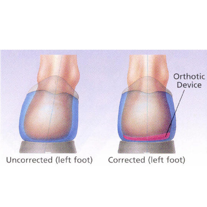 orthotics